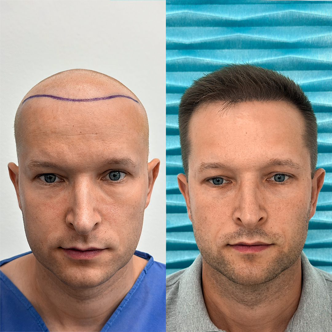 Przeszczep włosów – jak wybrać metodę i odpowiednią klinikę?